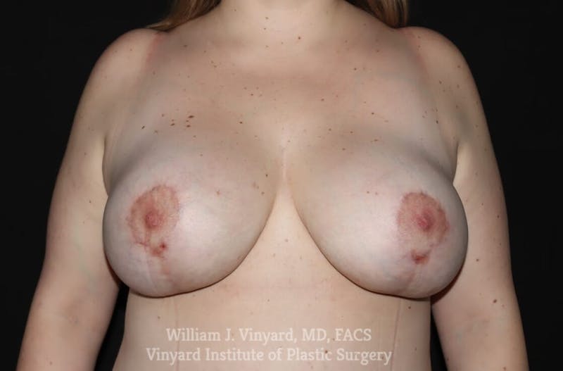 Breast Lift Before & After Gallery - Patient 169746272 - Image 4