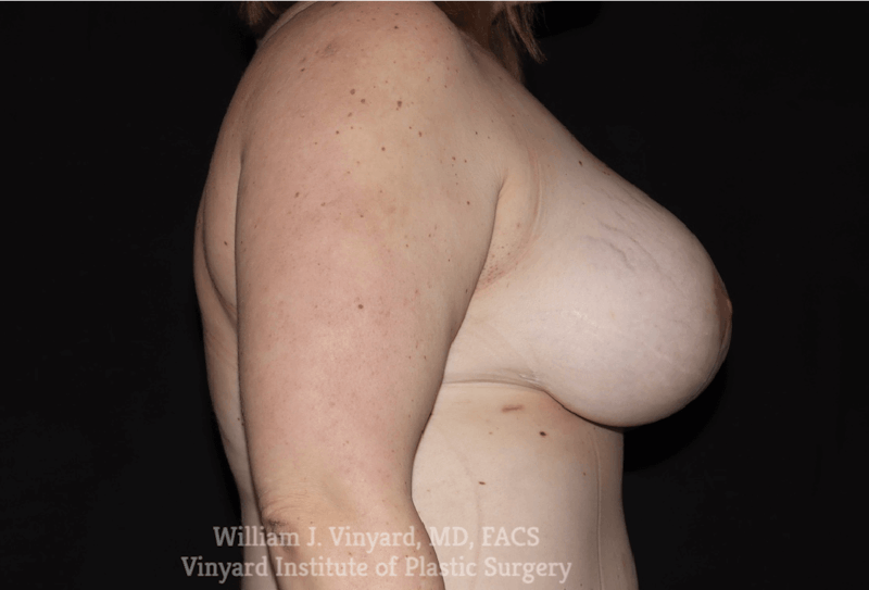 Breast Lift Before & After Gallery - Patient 169746272 - Image 6