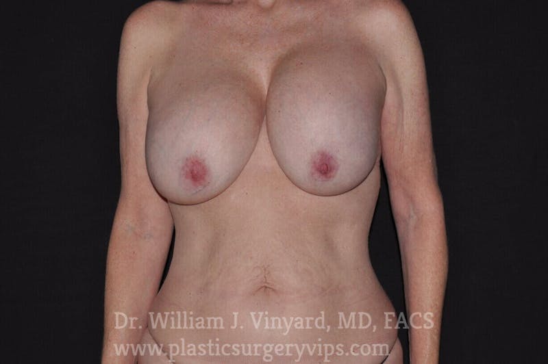 Breast Lift Before & After Gallery - Patient 169746273 - Image 1