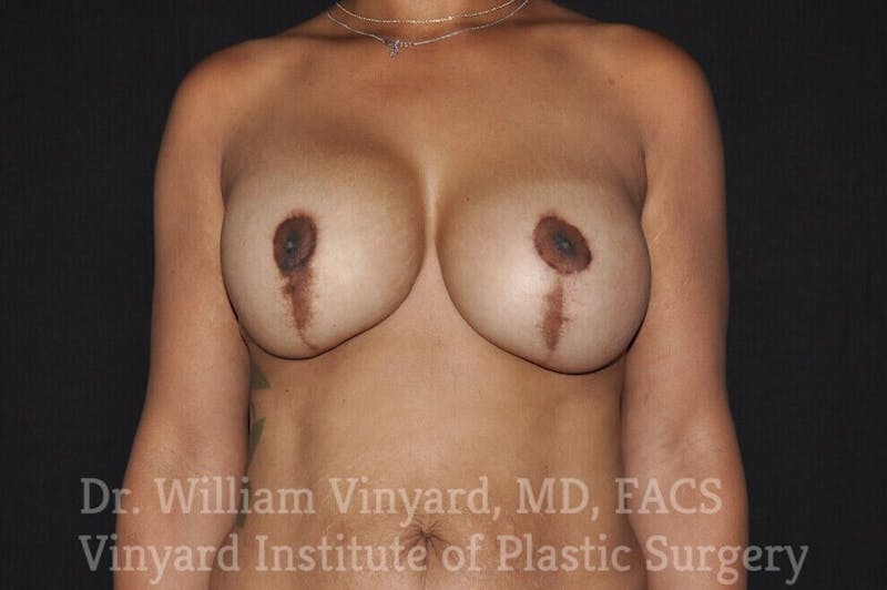 Breast Lift Before & After Gallery - Patient 169747236 - Image 1
