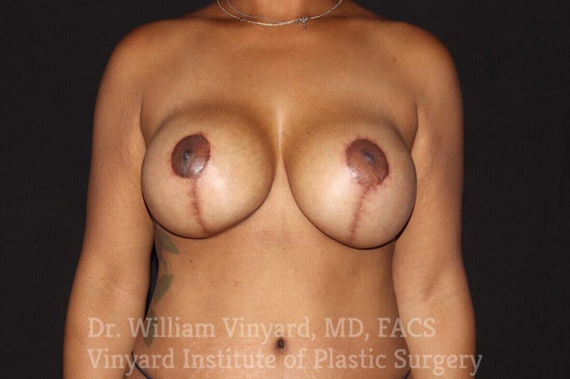 Breast Lift Before & After Gallery - Patient 169747236 - Image 2