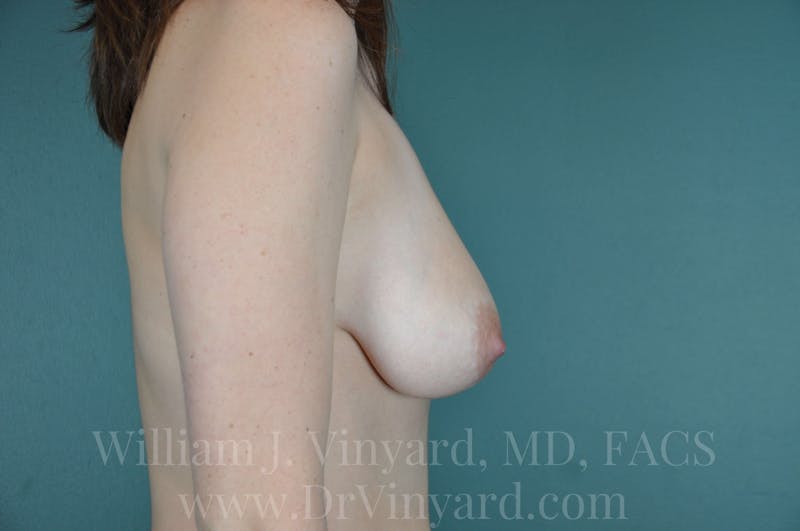 Breast Lift Before & After Gallery - Patient 169749116 - Image 1