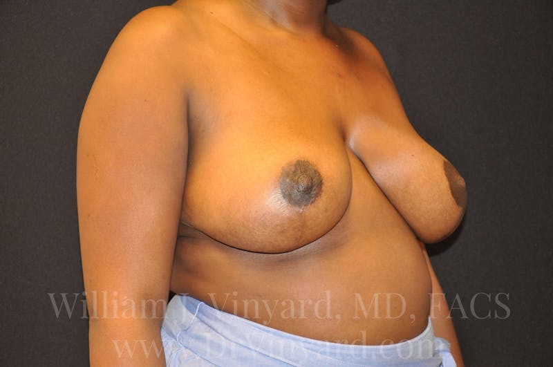 Breast Reduction Before & After Gallery - Patient 169749652 - Image 4