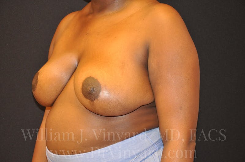 Breast Reduction Before & After Gallery - Patient 169749652 - Image 8