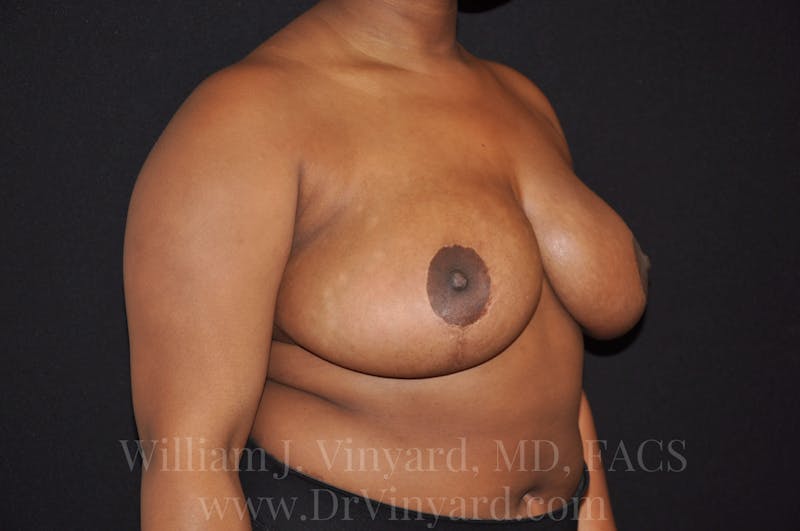 Breast Reduction Before & After Gallery - Patient 169750171 - Image 4