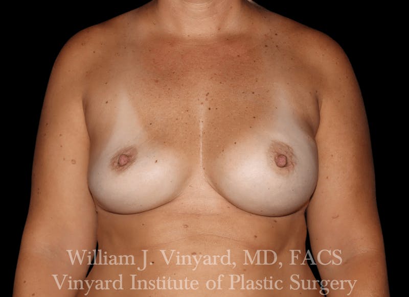 Breast Implant Exchange Before & After Gallery - Patient 169750790 - Image 1