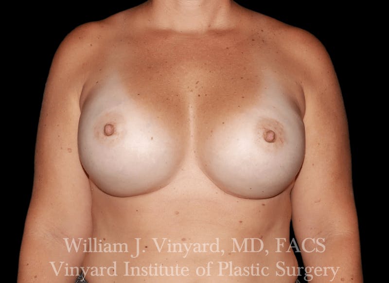 Breast Revision Before & After Gallery - Patient 169750790 - Image 2