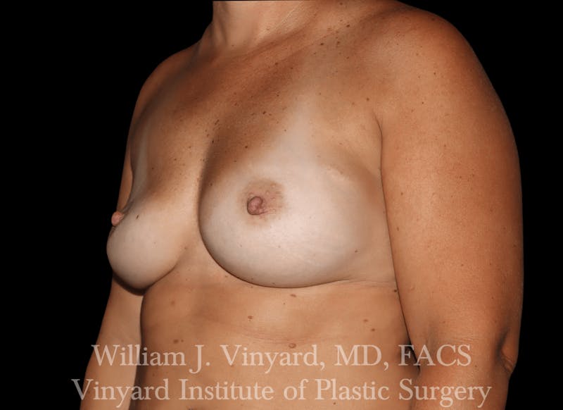 Breast Implant Exchange Before & After Gallery - Patient 169750790 - Image 3