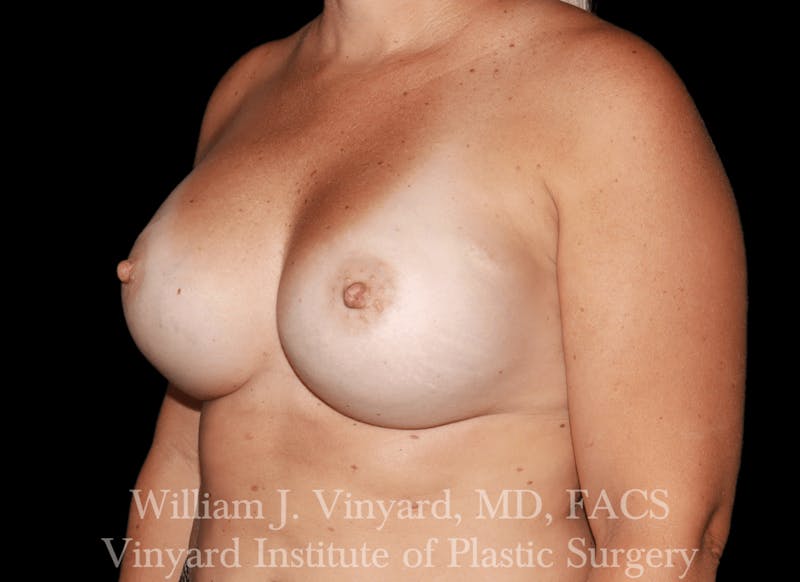 Breast Implant Exchange Before & After Gallery - Patient 169750790 - Image 4