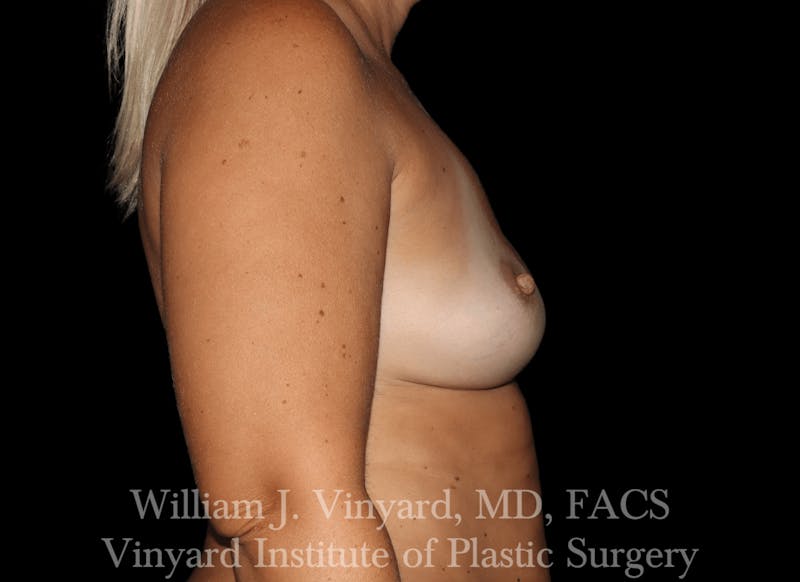 Breast Implant Exchange Before & After Gallery - Patient 169750790 - Image 5