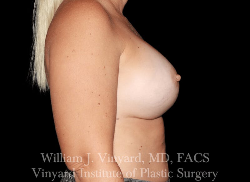 Breast Implant Exchange Before & After Gallery - Patient 169750790 - Image 6