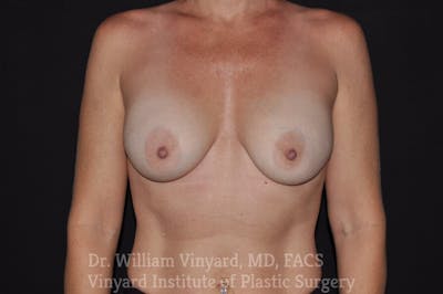 Breast Implant Exchange Before & After Gallery - Patient 169751119 - Image 1