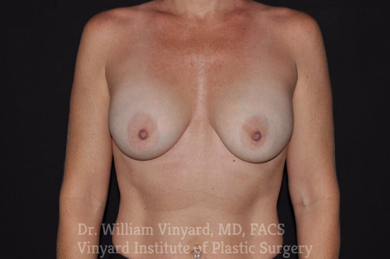 Breast Revision Before & After Gallery - Patient 169751119 - Image 1