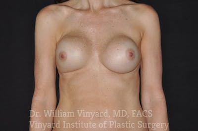 Breast Implant Exchange Before & After Gallery - Patient 169751339 - Image 1