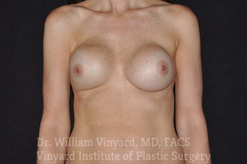 Breast Implant Exchange Before & After Gallery - Patient 169751339 - Image 1