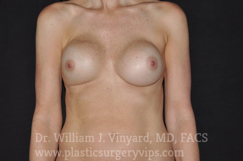 Breast Revision Before & After Gallery - Patient 169751342 - Image 1