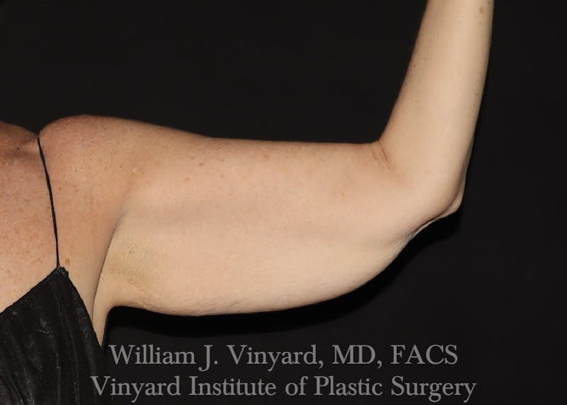 Arm Lift Before & After Gallery - Patient 169751356 - Image 1