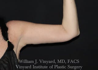 Arm Lift Before & After Gallery - Patient 169751356 - Image 2