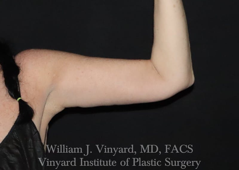 Arm Lift Before & After Gallery - Patient 169751356 - Image 2