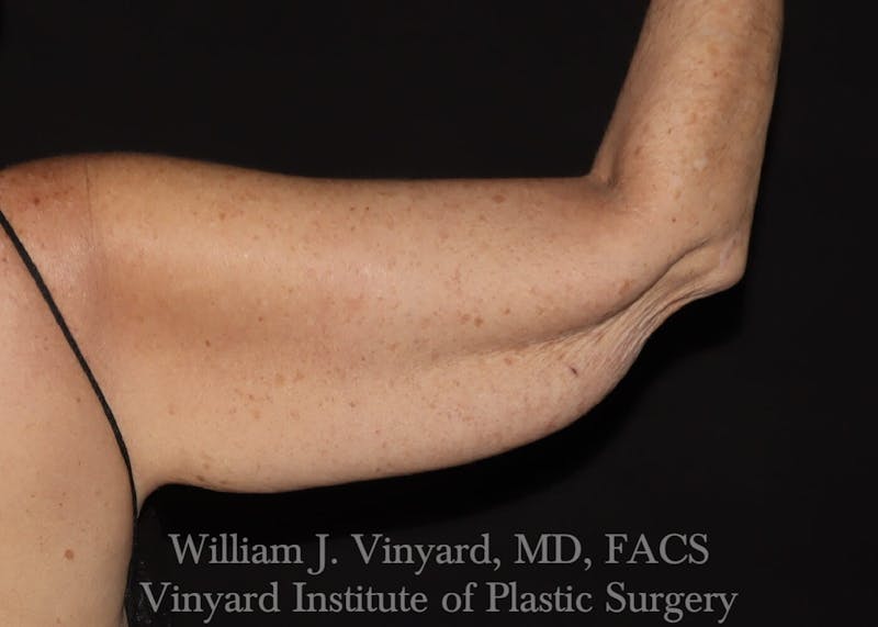 Arm Lift Before & After Gallery - Patient 169751356 - Image 3