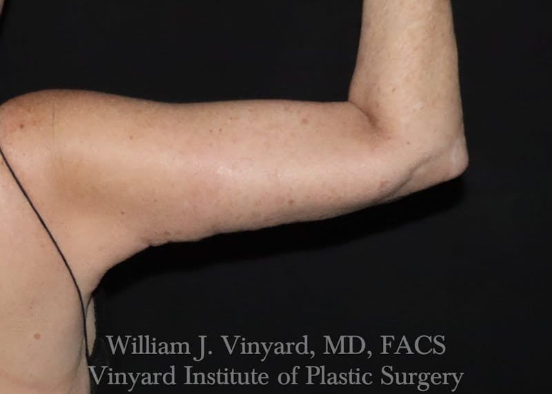 Arm Lift Before & After Gallery - Patient 169751356 - Image 4