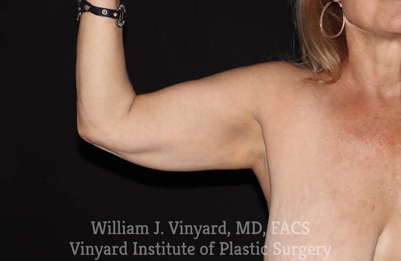 Arm Lift Before & After Gallery - Patient 169751750 - Image 1