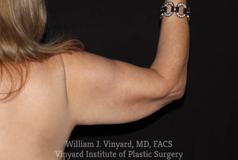 Arm Lift Before & After Gallery - Patient 169751750 - Image 3