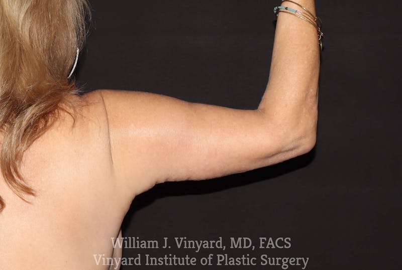 Arm Lift Before & After Gallery - Patient 169751750 - Image 4