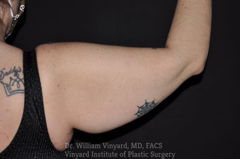 Arm Lift Before & After Gallery - Patient 169751912 - Image 1
