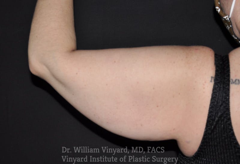 Arm Lift Before & After Gallery - Patient 169751912 - Image 3