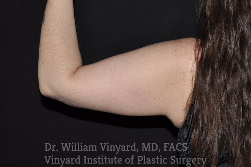Arm Lift Before & After Gallery - Patient 169751912 - Image 4