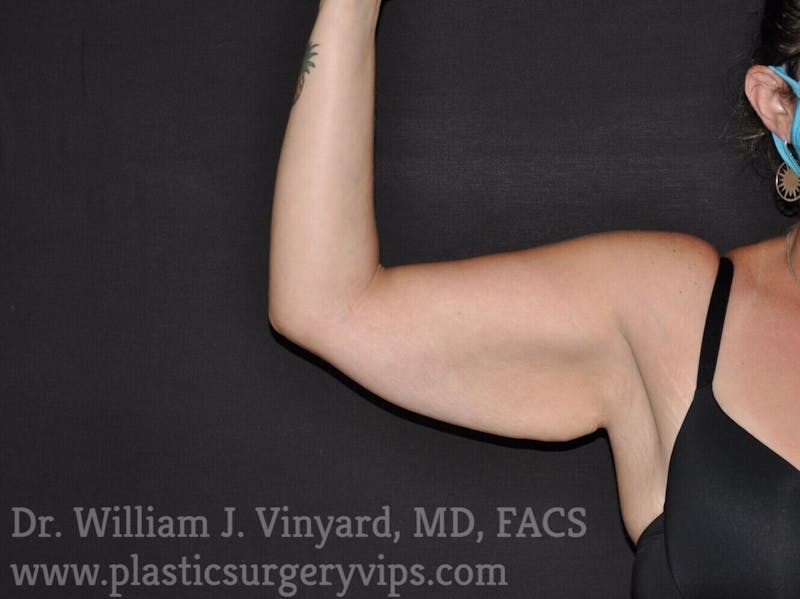 Arm Lift Before & After Gallery - Patient 169751914 - Image 3