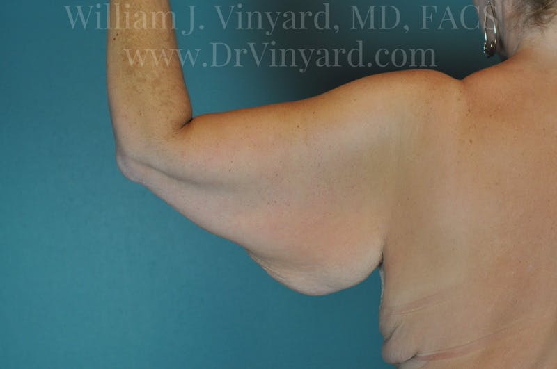 Arm Lift Before & After Gallery - Patient 169751922 - Image 1