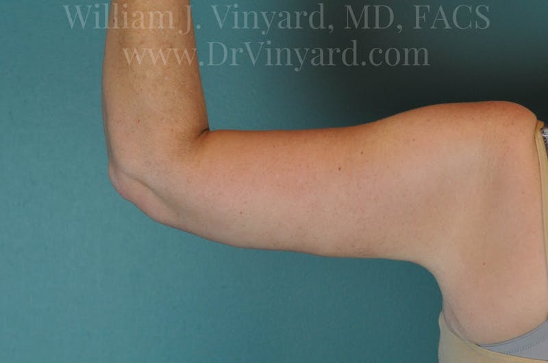 Arm Lift Before & After Gallery - Patient 169751922 - Image 2