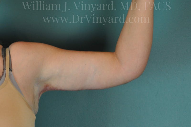 Arm Lift Before & After Gallery - Patient 169751922 - Image 4