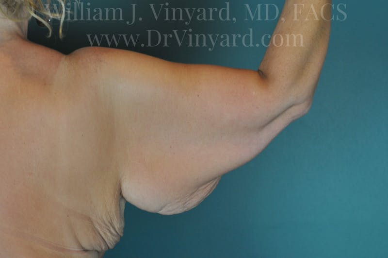 Arm Lift Before & After Gallery - Patient 169751922 - Image 5