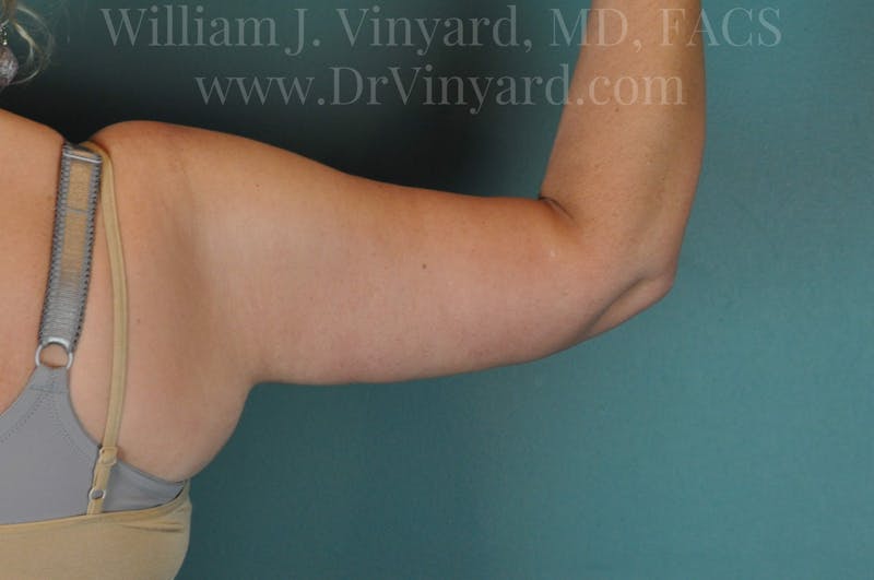 Arm Lift Before & After Gallery - Patient 169751922 - Image 6