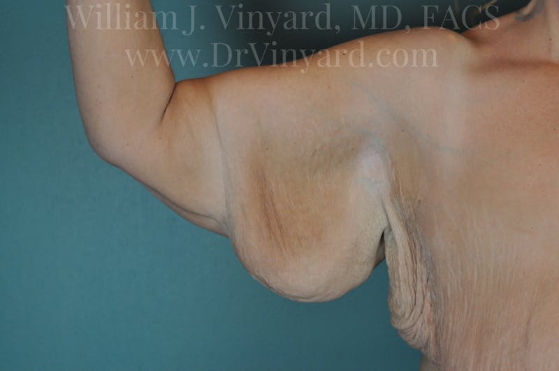 Arm Lift Before & After Gallery - Patient 169751922 - Image 7