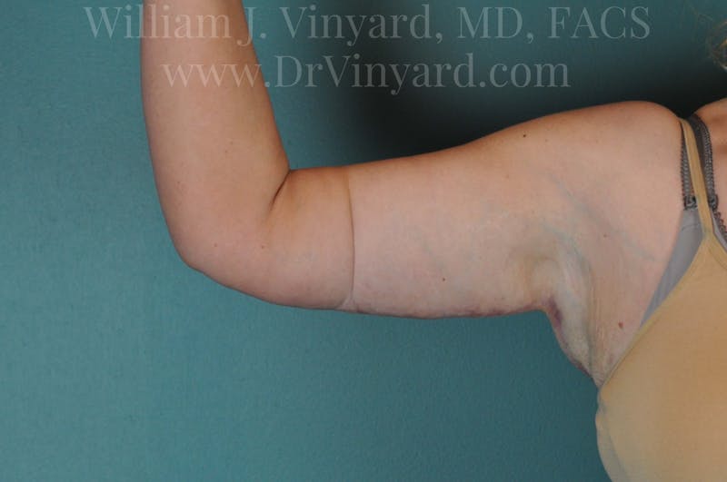 Arm Lift Before & After Gallery - Patient 169751922 - Image 8