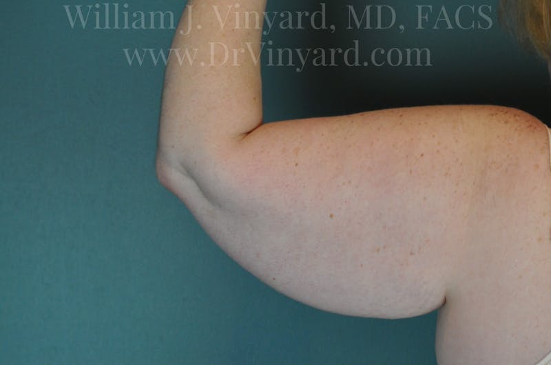 Arm Lift Before & After Gallery - Patient 169752453 - Image 1