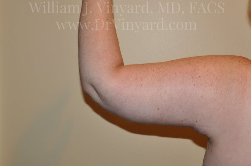 Arm Lift Before & After Gallery - Patient 169752453 - Image 2