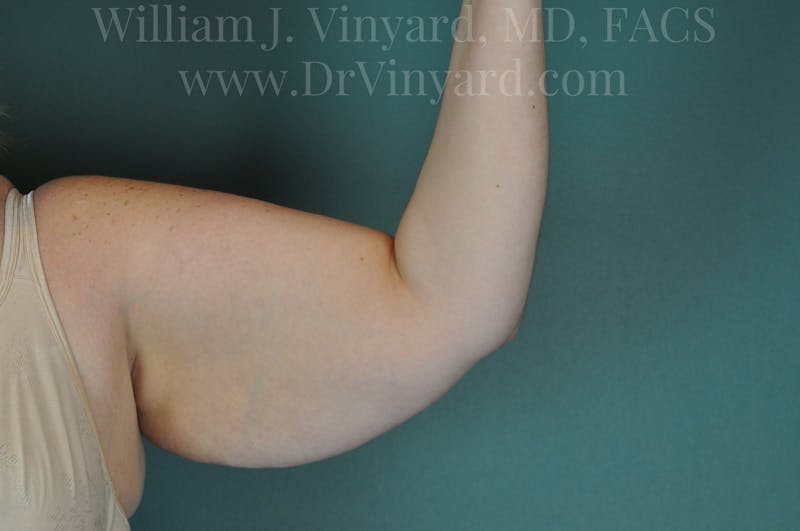 Arm Lift Before & After Gallery - Patient 169752453 - Image 3