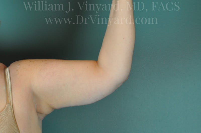 Arm Lift Before & After Gallery - Patient 169752453 - Image 4