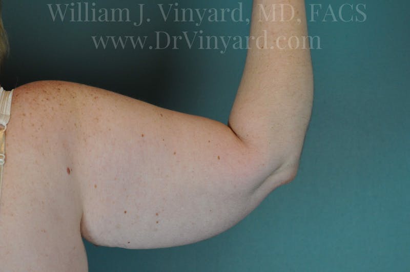 Arm Lift Before & After Gallery - Patient 169752453 - Image 5