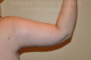 Arm Lift Before & After Gallery - Patient 169752453 - Image 6