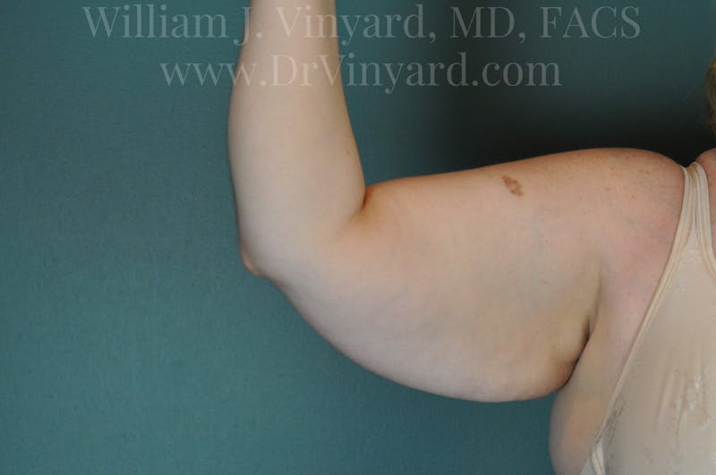 Arm Lift Before & After Gallery - Patient 169752453 - Image 7