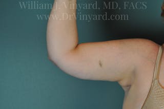 Arm Lift Before & After Gallery - Patient 169752453 - Image 8