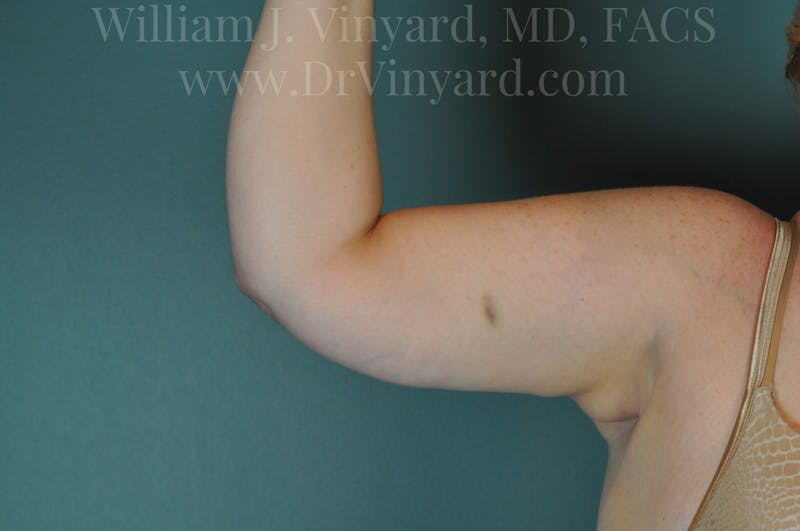 Arm Lift Before & After Gallery - Patient 169752453 - Image 8