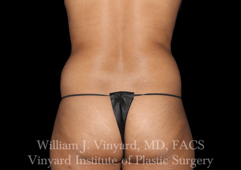 Liposuction Before & After Gallery - Patient 169753790 - Image 1