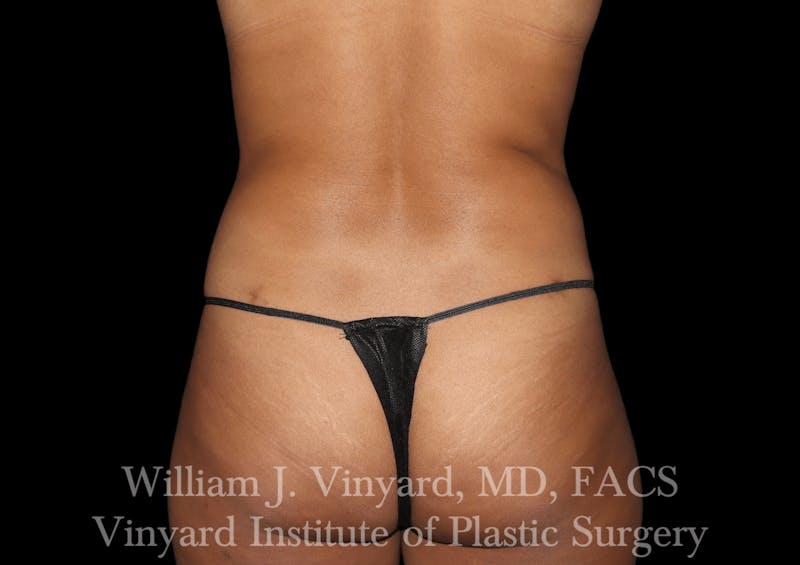 Liposuction Before & After Gallery - Patient 169753790 - Image 2